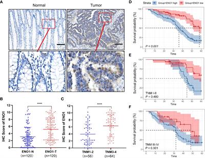 ENO1 contributes to 5-fluorouracil resistance in colorectal cancer cells via EMT pathway